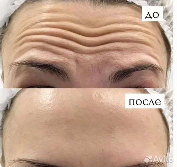 Коктейль Монако + ботокс