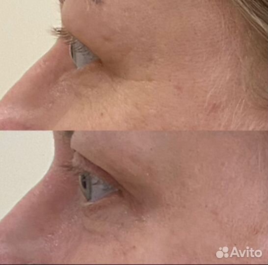 Холодная плазма