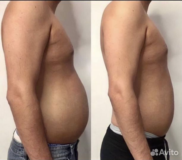 Криолиполиз для мужчин на новейшем аппарате