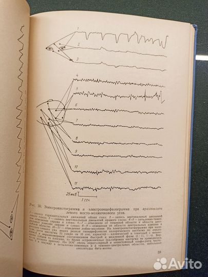 Электронистагмография при очаговых поражениях 1968