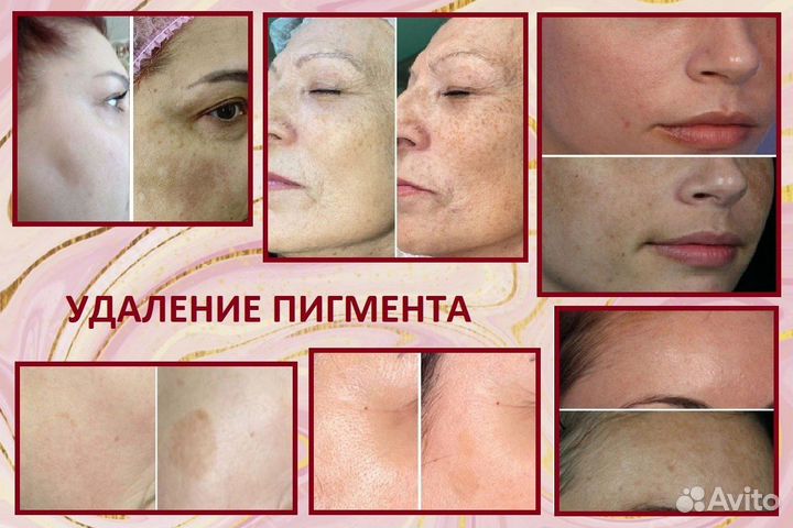 Холодный импульсный спрей, омоложение на 10 лет