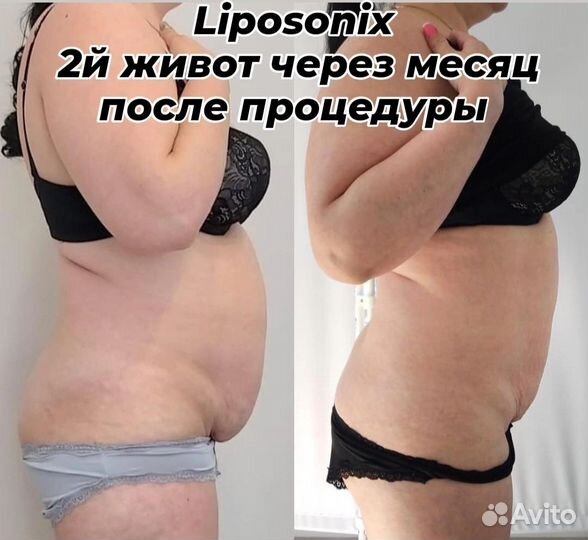 Подтяжка лица,омоложение