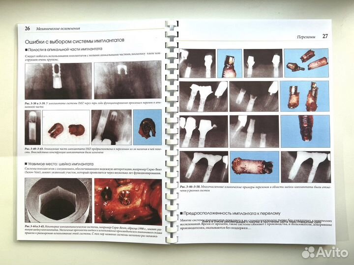 Устранение осложнений имплантологического лечения