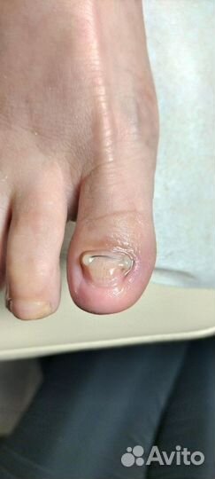 Ищу моделей с вросшим ногтем