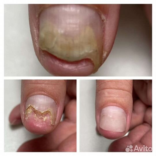 Подолог. Лечебный педикюр. Без боли