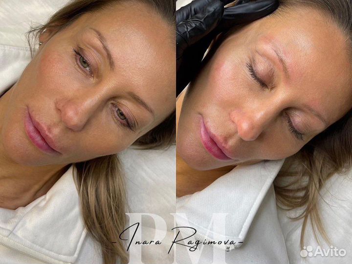 Лазерное удаление татуировок и татуажа