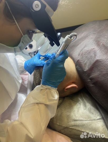 Пересадка волос методом FUE