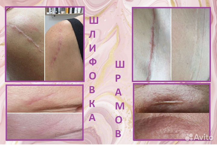 Холодный импульсный спрей, омоложение на 10 лет