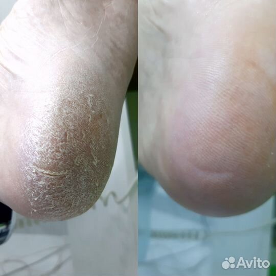 Подолог с выездом на дом