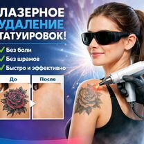 Удаление татуировок лазером, Москва