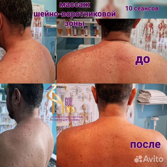 Массаж спины и шейно-воротниковой зоны