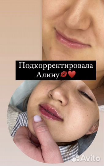 Увеличение губ