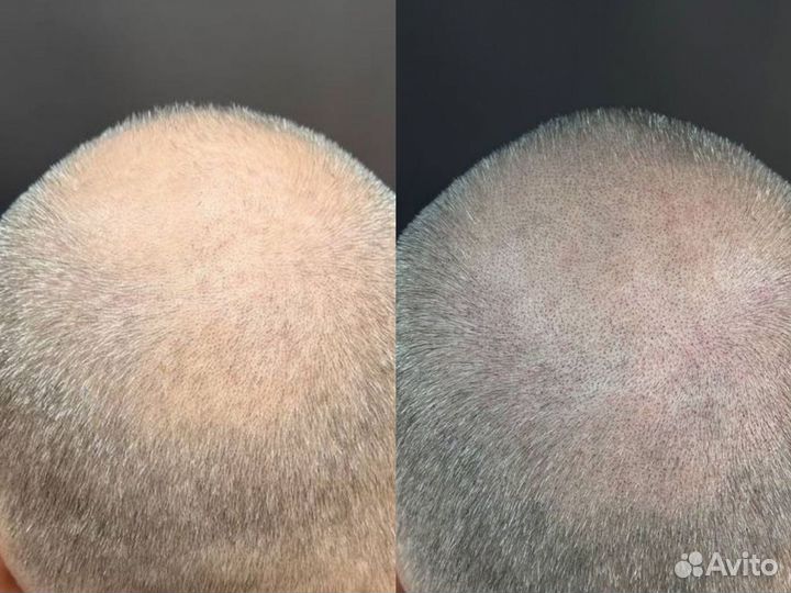 Ищу модель на трихопигментацию SMP