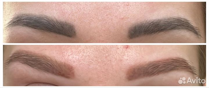 Лазерное удаление тату и татуажа