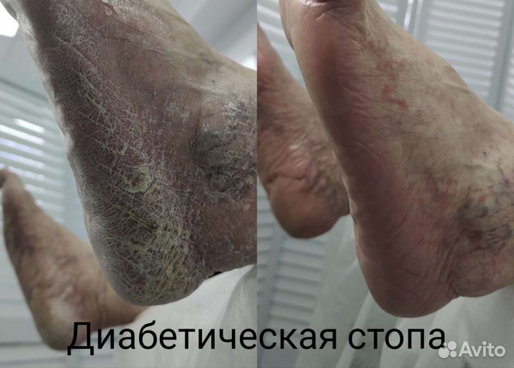 Подология. Педикюр. Медицинский педикюр