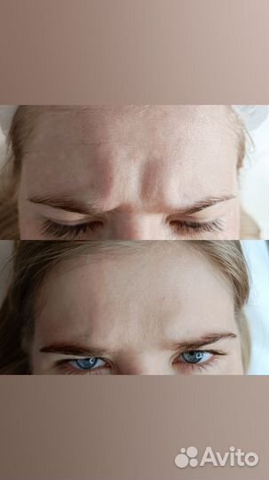 Ботокс лица