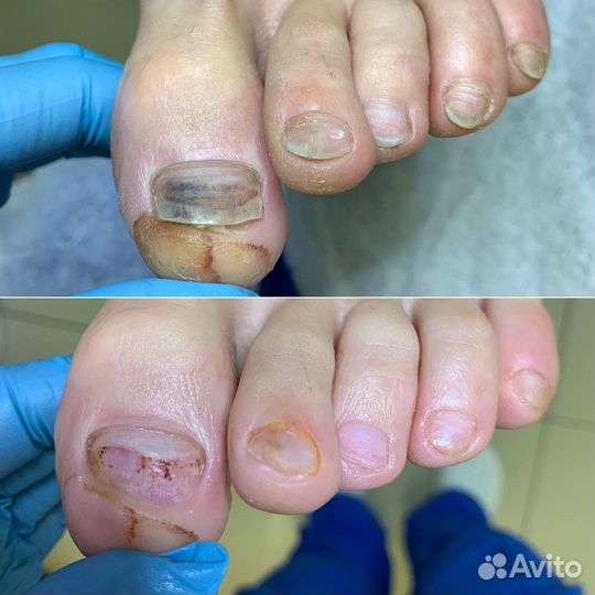 Услуги подолога / выезд на дом