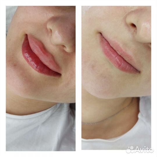 Увеличение губ,косметолог, ботокс
