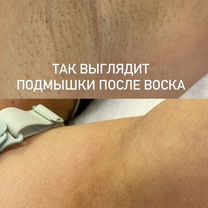 Лазерная эпиляция Видное, Видное
