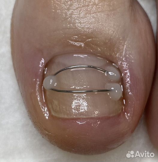 Педикюр/медицинский педикюр