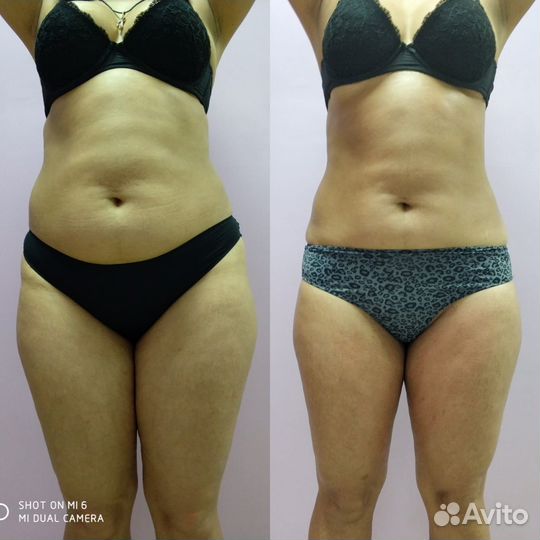 Антицеллюлитный вакуумный LPG массаж