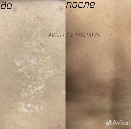 Удаление шрамов Камуфляж рубцов растяжек витилиго