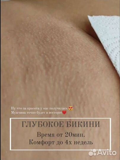 Шугаринг, эпиляция