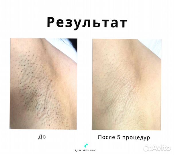 Диодный лазер для эпиляции lumines Max’One 1200 Вт