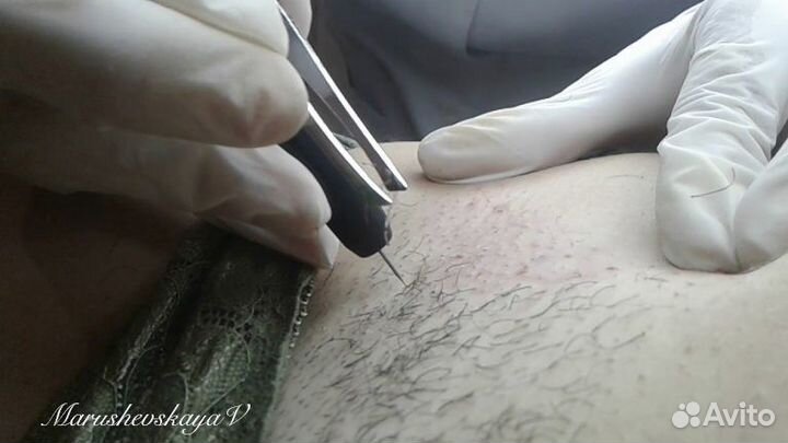 Электроэпиляция для мужчин и женщин