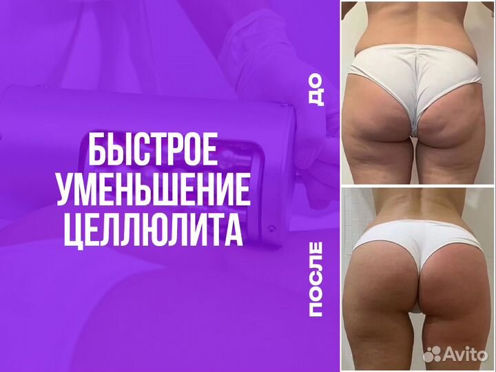 Корекция фигуры, аппаратный массаж