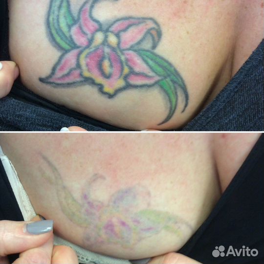 Лазер для удаления тату с обучением