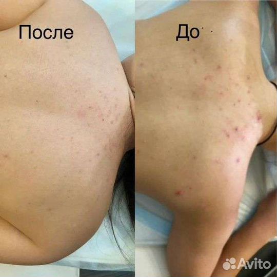 Карбоновый пилинг