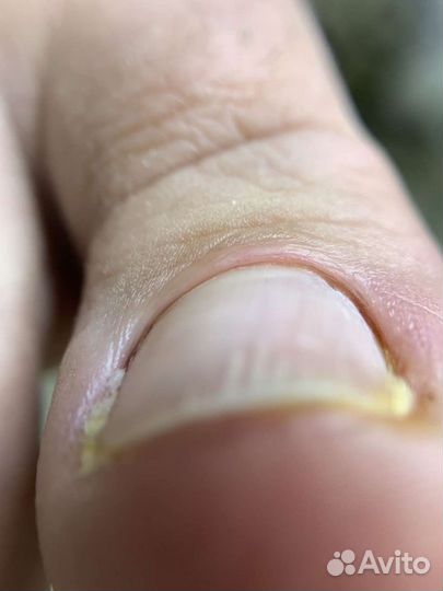 Медицинский педикюр,подолог