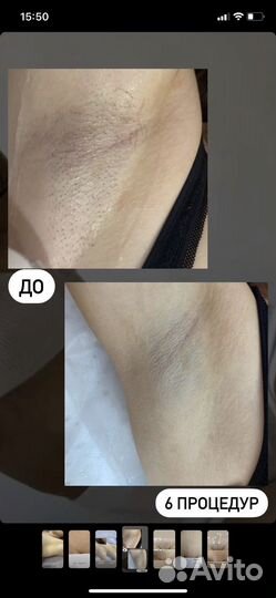 Лазерная эпиляция