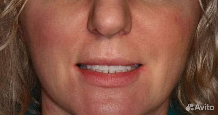 Съёмные/зубные протезы,коронки на зуб