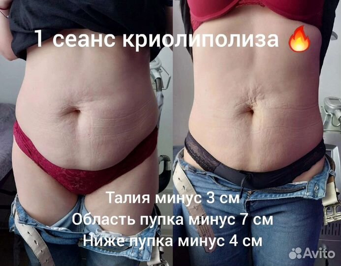 Криолиполиз