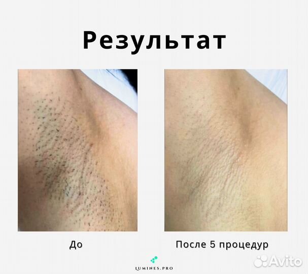 Диодный лазер Lumines-M Макс Ван 1200вт