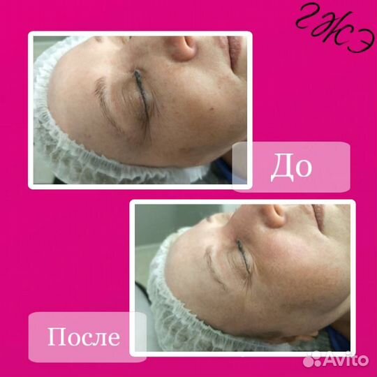 Убрать заломы, убрать морщины, лифтинг