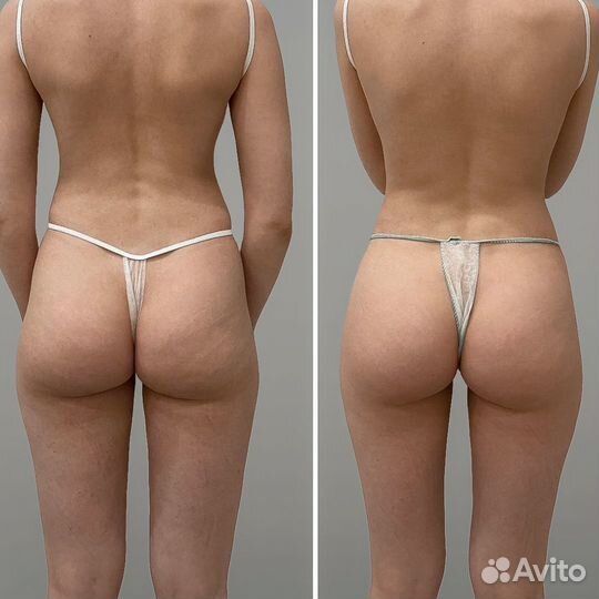 Похудение коррекция фигуры, RSL скульптурирование