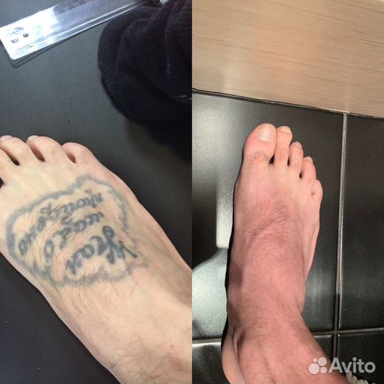 Удаление тату и татуажа