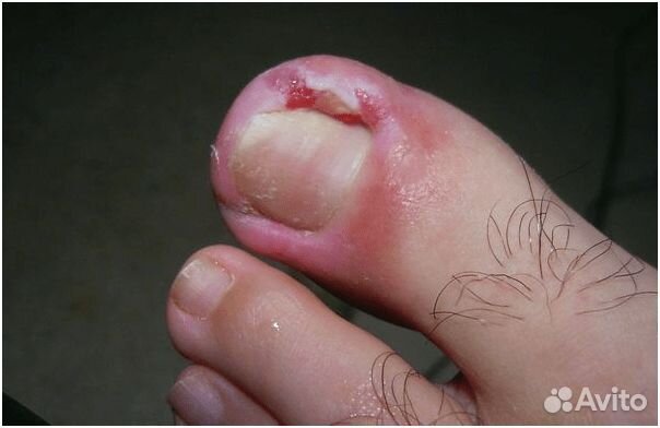 Вросший ноготь 