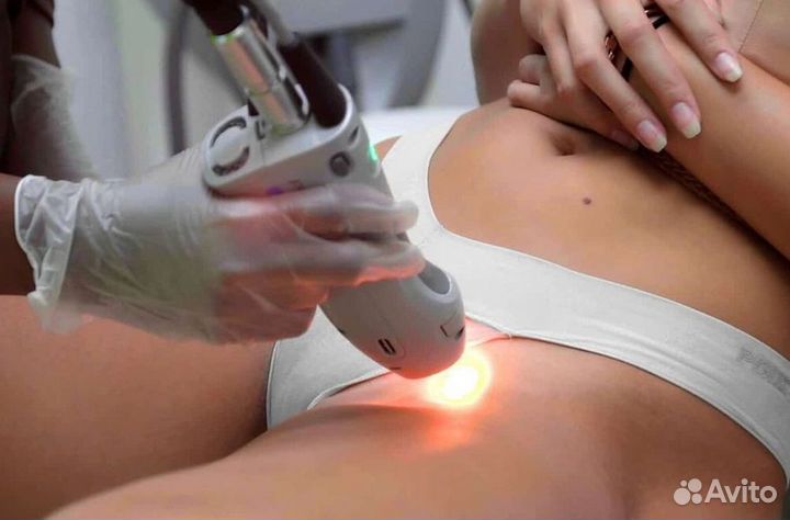 Лазерная эпиляция – готовый бизнес под ключ
