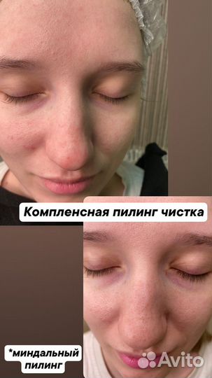 Ультразвуковая чистка лица