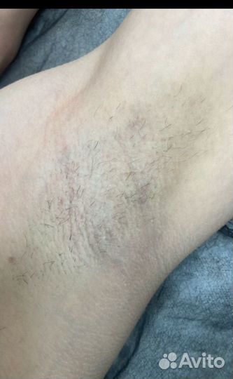 Электроэпиляция