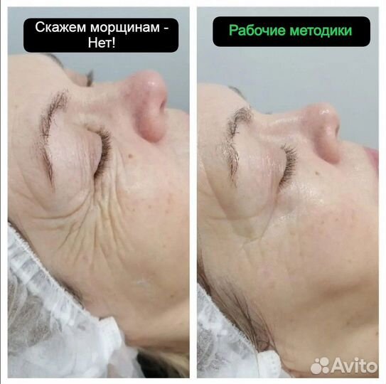 Подтяжка лица. Омоложение. Аппаратная косметология