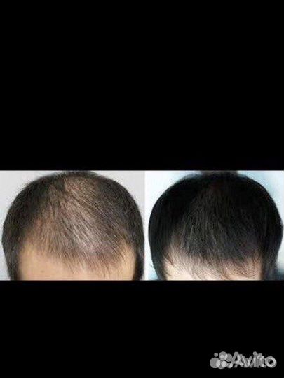 Средство для роста волос и бороды