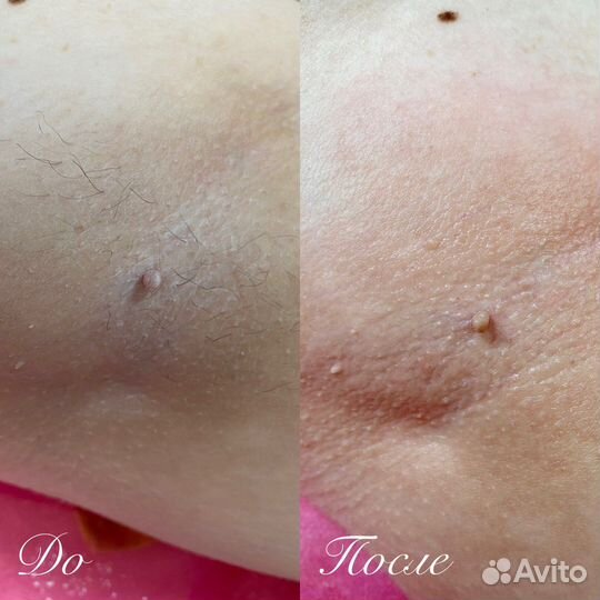 Шугаринг женский сжм