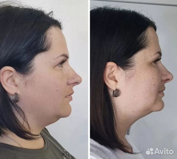 Убираем второй подбородок навсегда. Криолиполиз