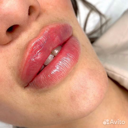 Увеличение губ модель