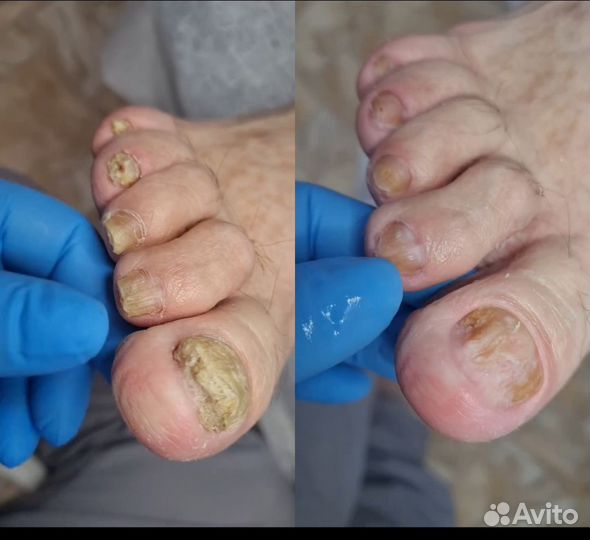 Подолог. Педикюр проблемной стопы